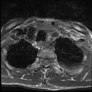 File:Nasopharyngeal carcinoma with skull base invasion (Radiopaedia 59258-66600 Axial T1 24).jpg