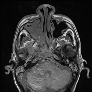 Nasopharyngeal carcinoma with skull base invasion (Radiopaedia 59258-66600 B 15).jpg