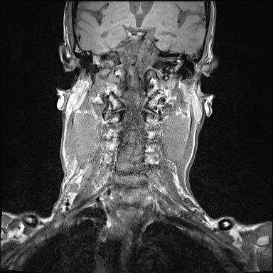 File:Nasopharyngeal carcinoma with skull base invasion (Radiopaedia 59258-66600 Coronal T1 12).jpg