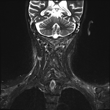 Nasopharyngeal carcinoma with skull base invasion (Radiopaedia 59258-66600 Coronal T2 fat sat 3).jpg