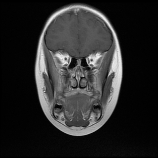 File:Nasopharyngeal rhabdomyosarcoma (Radiopaedia 23417-23486 Coronal T1 C+ 5).jpg