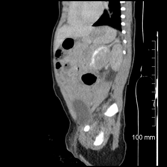 File:Neonatal neuroblastoma (Radiopaedia 56651-63438 C 36).jpg