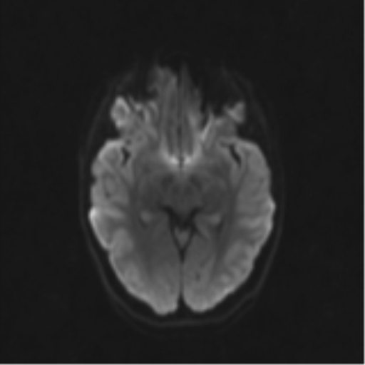 Neurenteric cyst (Radiopaedia 58641-65837 Axial DWI 51).png