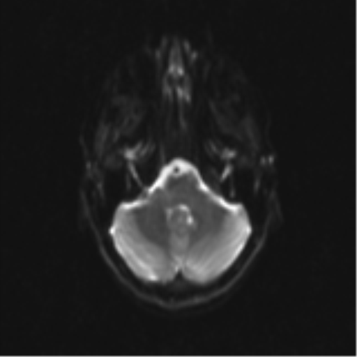 Neurenteric cyst (Radiopaedia 58641-65837 Axial DWI 9).png