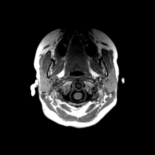 Neurenteric cyst (Radiopaedia 58641-65837 Axial T1 4).png