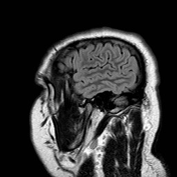 File:Neuro-Behcet's disease (Radiopaedia 21557-21506 Sagittal FLAIR 32).jpg