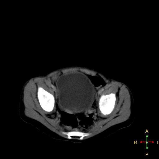 File:Neuroblastoma (Radiopaedia 24751-25016 D 38).jpg