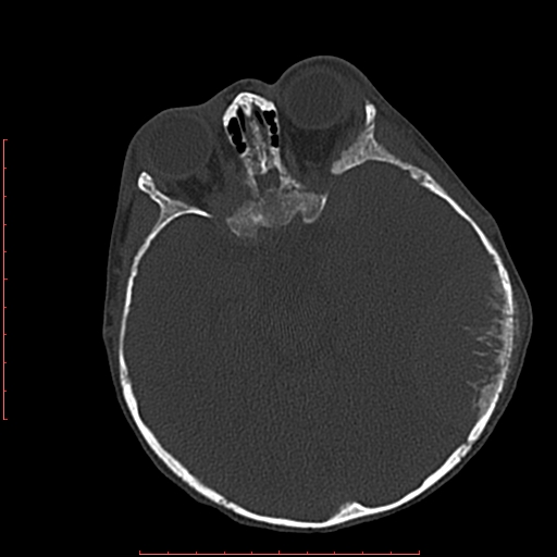 File:Neuroblastoma skull metastasis (Radiopaedia 56053-62683 Axial bone window 11).jpg