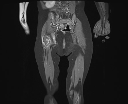 File:Neuroblastoma with bone metastases (Radiopaedia 67080-76414 E 19).jpg