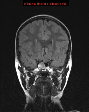 File:Neurofibromatosis type 1 with optic nerve glioma (Radiopaedia 16288-15965 Coronal FLAIR 17).jpg