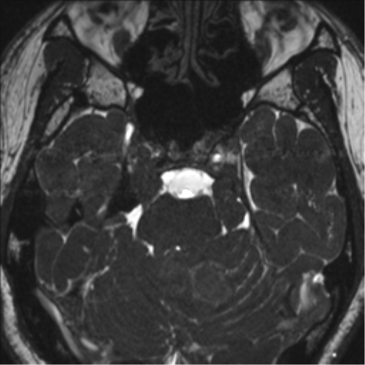 Neurofibromatosis type 2 (Radiopaedia 44936-48838 E 40).png