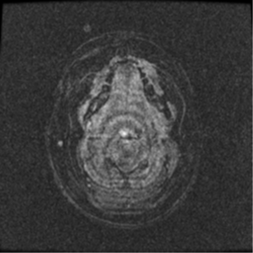 Neurofibromatosis type 2 (Radiopaedia 45229-49244 Axial T1 C+ 119).png
