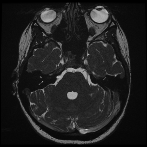Neurofibromatosis type 2 - bilateral acoustic neuromata (Radiopaedia 40060-42566 Axial FIESTA 49).png
