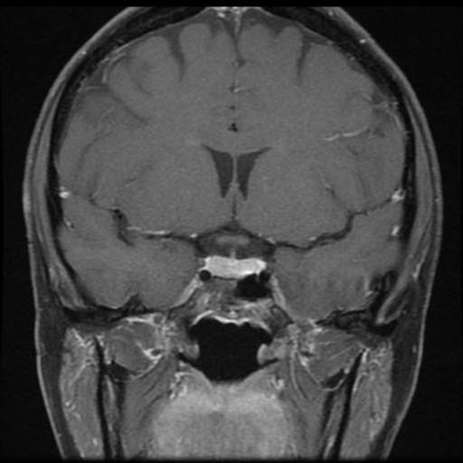 File:Neurofibromatosis type 2 - bilateral acoustic neuromata (Radiopaedia 40060-42566 Coronal T1 C+ 11).png