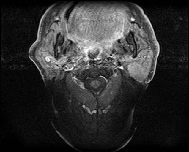 File:Non-Hodgkin lymphoma - parotid gland (Radiopaedia 71531-81890 Axial T1 C+ fat sat 13).jpg