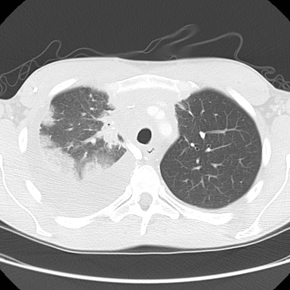 File:Non-Hodgkin lymphoma involving lung (Radiopaedia 29094-29470 Axial lung window 22).jpg