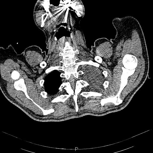 File:Non Hodgkin lymphoma in a patient with ankylosing spondylitis (Radiopaedia 84323-99621 Axial non-contrast 1).jpg