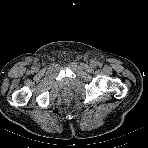 File:Non Hodgkin lymphoma in a patient with ankylosing spondylitis (Radiopaedia 84323-99621 Axial non-contrast 63).jpg