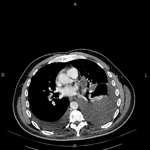 File:Non Hodgkin lymphoma in a patient with ankylosing spondylitis (Radiopaedia 84323-99621 B 19).jpg