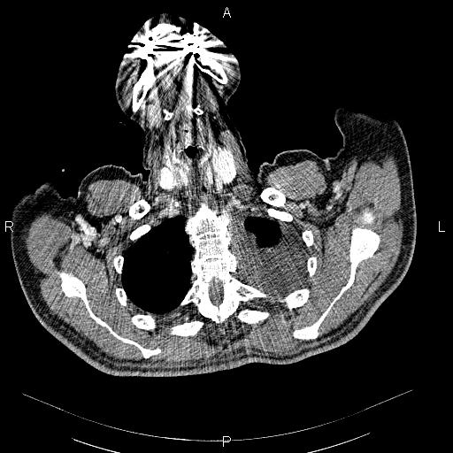 File:Non Hodgkin lymphoma in a patient with ankylosing spondylitis (Radiopaedia 84323-99621 B 5).jpg