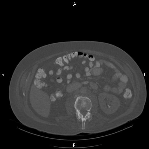 Non Hodgkin lymphoma in a patient with ankylosing spondylitis (Radiopaedia 84323-99624 Axial bone window 41).jpg