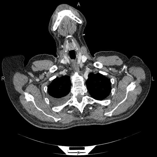 File:Non Hodgkin lymphoma in a patient with ankylosing spondylitis (Radiopaedia 84323-99624 B 5).jpg