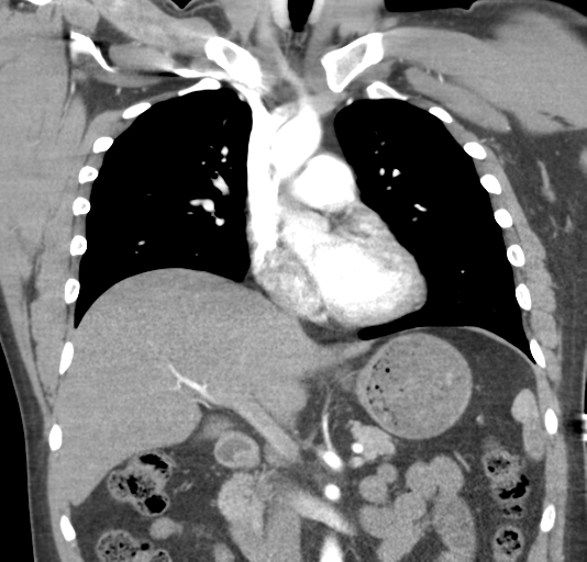 File:Normal CTA thorax (non ECG gated) (Radiopaedia 41750-44704 B 42).png