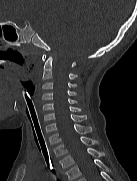 Normal CT cervical spine - pediatric (Radiopaedia 52549-58462 Sagittal bone window 100).jpg