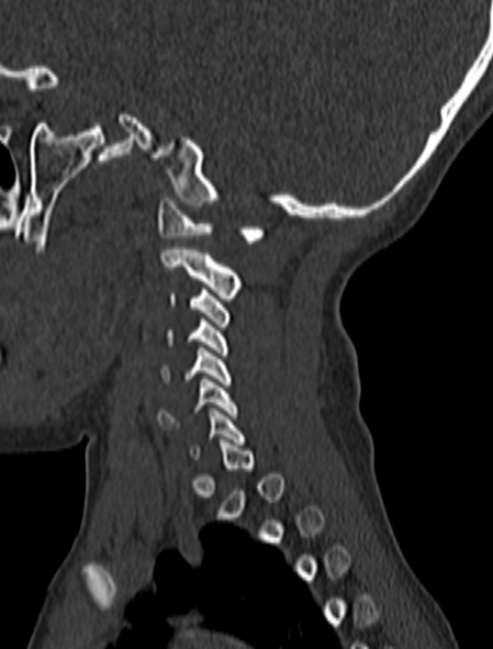 Normal CT cervical spine - pediatric (Radiopaedia 52549-58462 Sagittal bone window 166).jpg