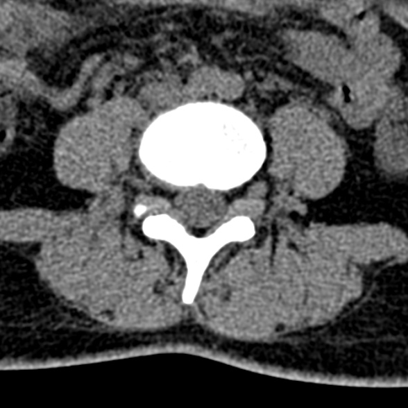 Normal CT lumbar spine (Radiopaedia 53981-60118 Axial non-contrast 68).jpg
