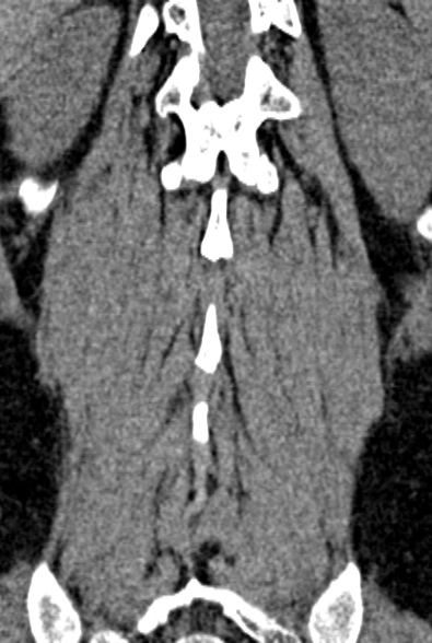 Normal CT lumbar spine (Radiopaedia 53981-60118 F 82).jpg