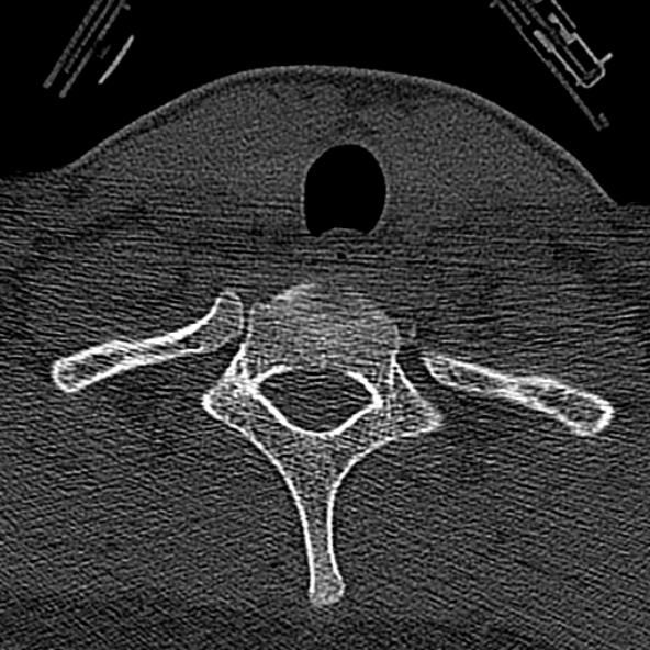 Normal CT of the cervical spine (Radiopaedia 53322-59305 Axial bone window 230).jpg