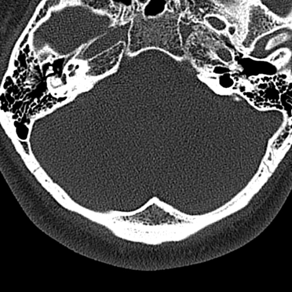 File:Normal CT of the cervical spine (Radiopaedia 53322-59305 Axial bone window 9).jpg