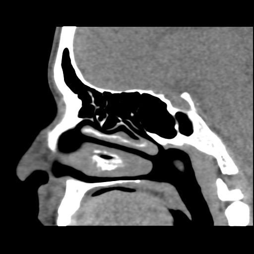 Normal CT paranasal sinuses (Radiopaedia 42286-45390 F 69).jpg