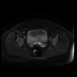 Normal MRI abdomen in pregnancy (Radiopaedia 88005-104548 Axial DWI 52).jpg