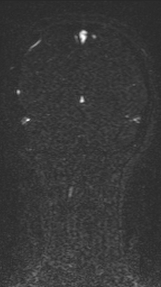 Normal MRI brain with MRV- teenager (Radiopaedia 49425-54553 Coronal MRV 193).jpg