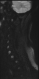 File:Normal MRI cervical spine (infection protocol) (Radiopaedia 53916-60039 Sagittal DWI 28).png