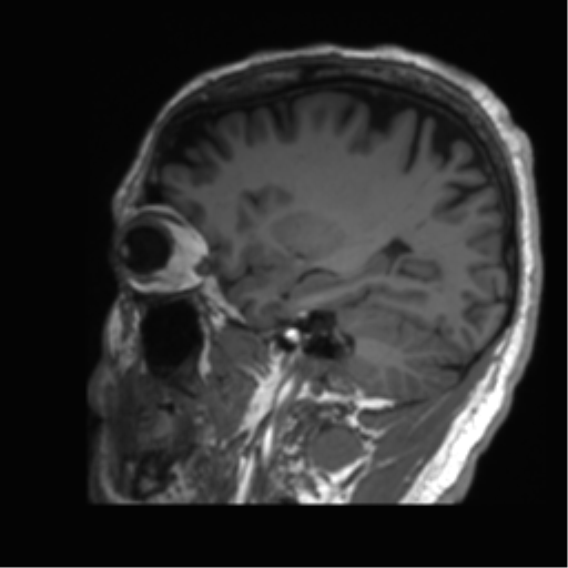 Normal brain MRI (non-focal epilepsy protocol) (Radiopaedia 53917-60040 Sagittal T1 48).png