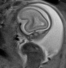 File:Normal brain fetal MRI - 22 weeks (Radiopaedia 50623-56050 Sagittal T2 Haste 17).jpg