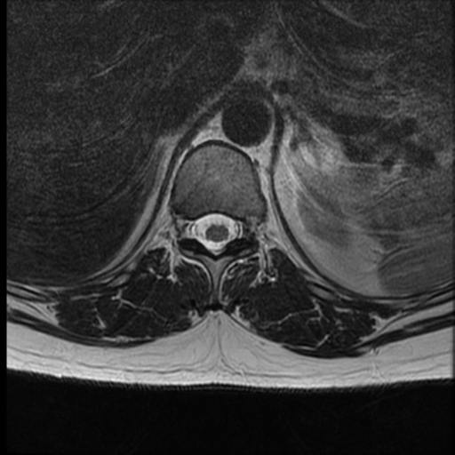 File:Normal cervical and thoracic spine MRI (Radiopaedia 35630-37156 H 10).png