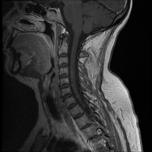 File:Normal cervical and thoracic spine MRI (Radiopaedia 35630-37156 Sagittal T1 C+ 5).png