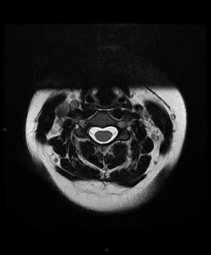 Normal cervical spine MRI (Radiopaedia 80146-93454 Axial T2 34).jpg