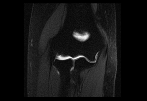 File:Normal elbow arthrograms (Radiopaedia 75550-86805 Coronal T1 fat sat 7).jpg