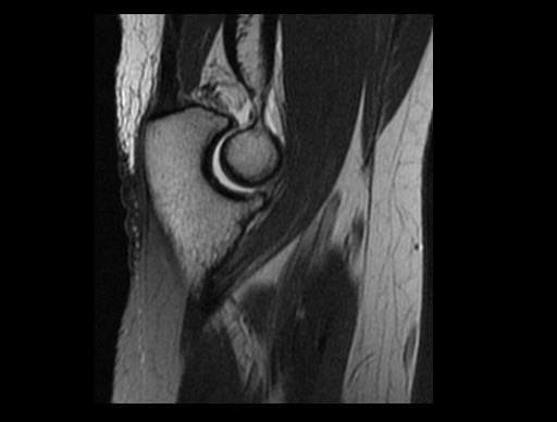 File:Normal elbow arthrograms (Radiopaedia 75550-86805 Sagittal PD 23).jpg