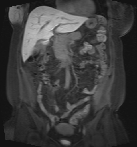 File:Normal hepatobiliary phase liver MRI (Radiopaedia 58968-66230 B 33).jpg