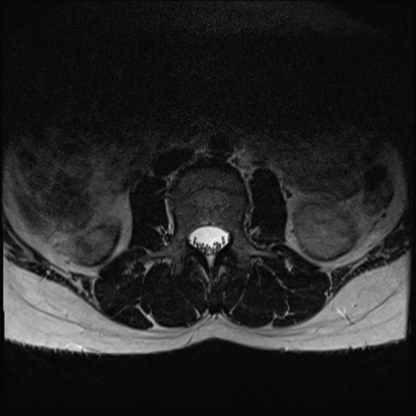 File:Normal lumbar spine MRI- 3 T (Radiopaedia 53280-59250 Axial T2 3).jpg