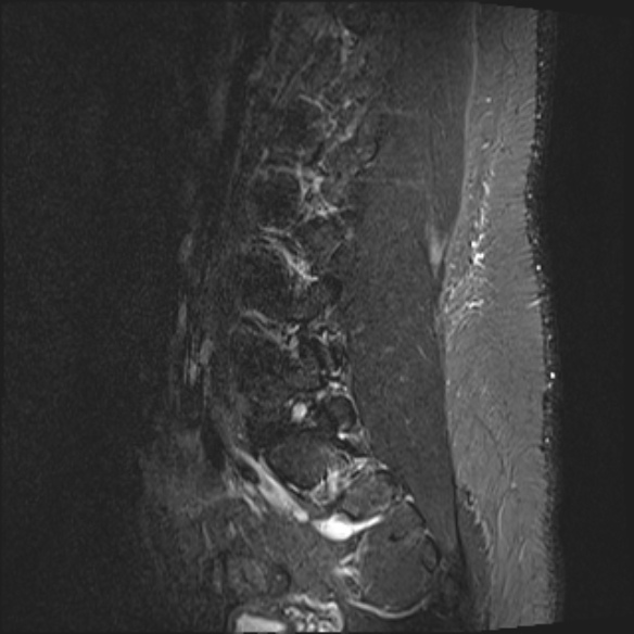 File:Normal lumbar spine MRI (Radiopaedia 47857-52609 Sagittal STIR 4).jpg