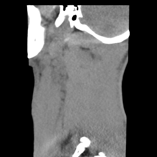File:Normal trauma cervical spine (Radiopaedia 41017-43760 B 28).png