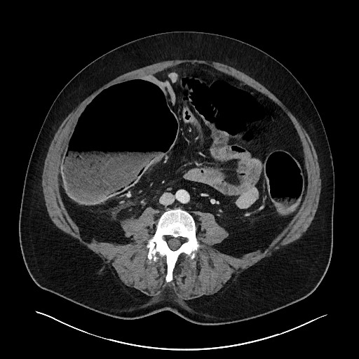 Obstructing sigmoid adenocarcinoma (Radiopaedia 58465-65619 A 100).jpg