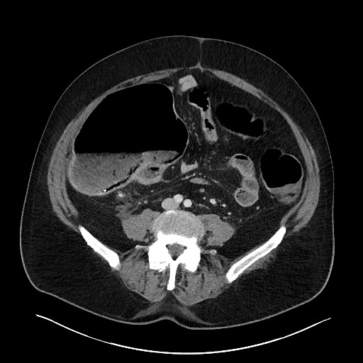 Obstructing sigmoid adenocarcinoma (Radiopaedia 58465-65619 A 106).jpg